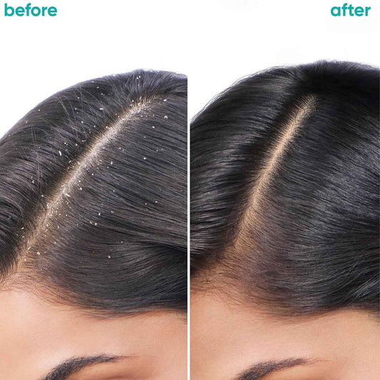 Biolage Professional Scalppure Anti-Dandruff Shampoo and Conditioner Combo, 200ml + 98g