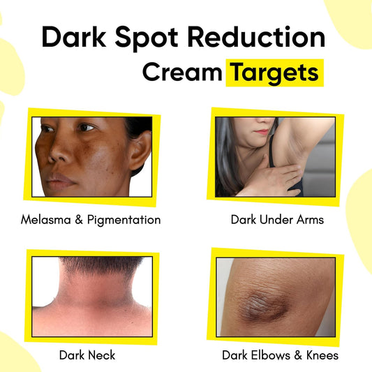 Masofta Dark Spot Reduction & Removal Cream for Melasma, Pigmentation, Acne Marks, 50 ml