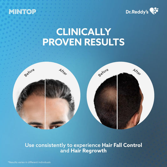 Mintop Forte 5% Solution Hair Restore Formula with Minoxidil, 60 ml