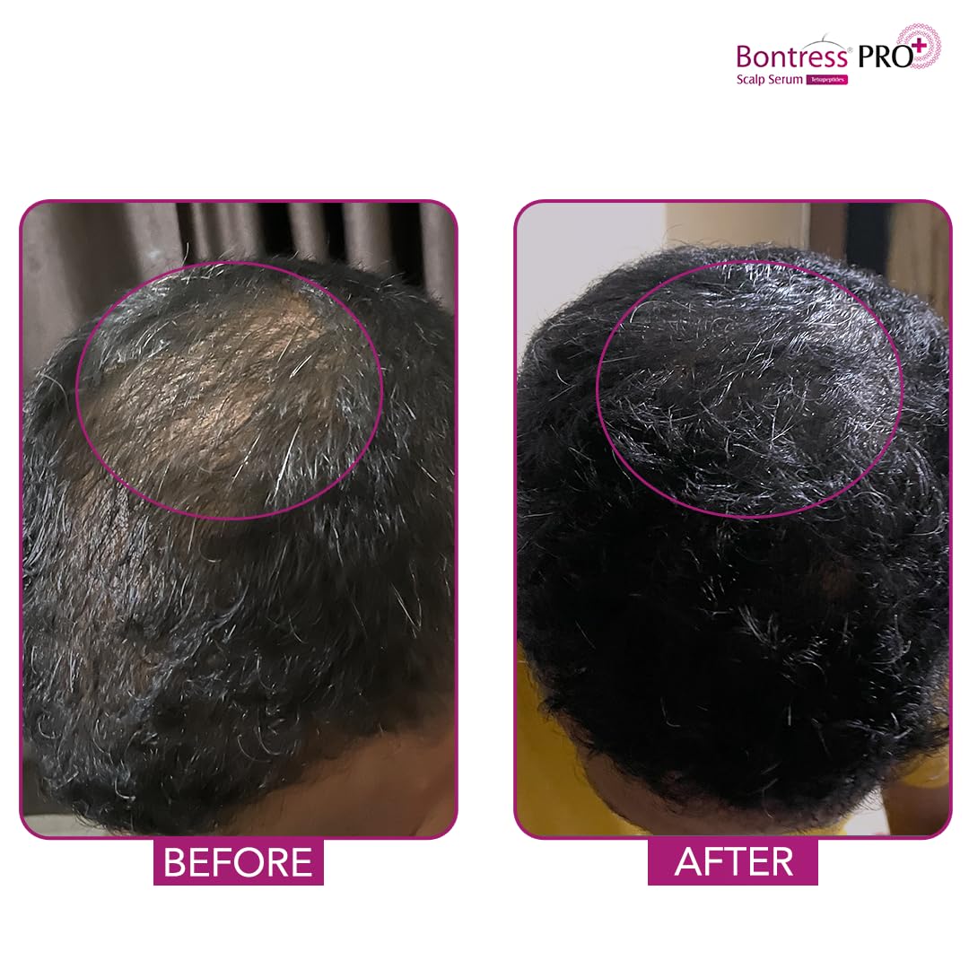 Bontress PRO+ Scalp Serum Fortified with Redensyl, Anagain, Capixyl,Procapil , 60 ml