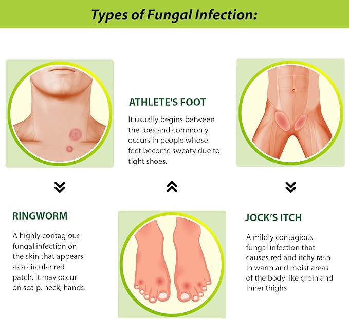 Tetmosol Anti-fungal Dusting Powder - For Daily Use - Fights Skin Infections, Prickly Heat, Itching - Pack of 2 (2x100g)