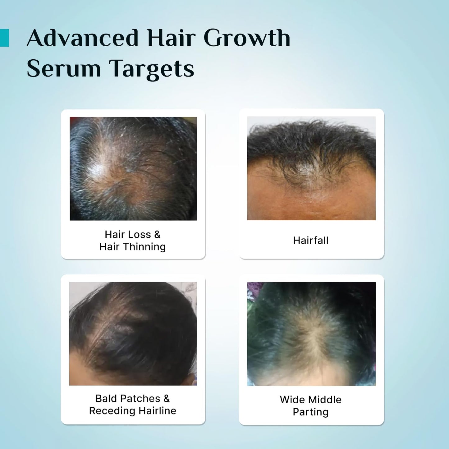 Pilgrim Redensyl 3% + Anagain 4% + Baicapil Advanced Hair Growth Serum (30ml) for Scalp with Korean Black Rice, Saw Palmetto | Control Hair Fall, Stimulate Hair Regrowth, Increase Hair Density | For Women & Men