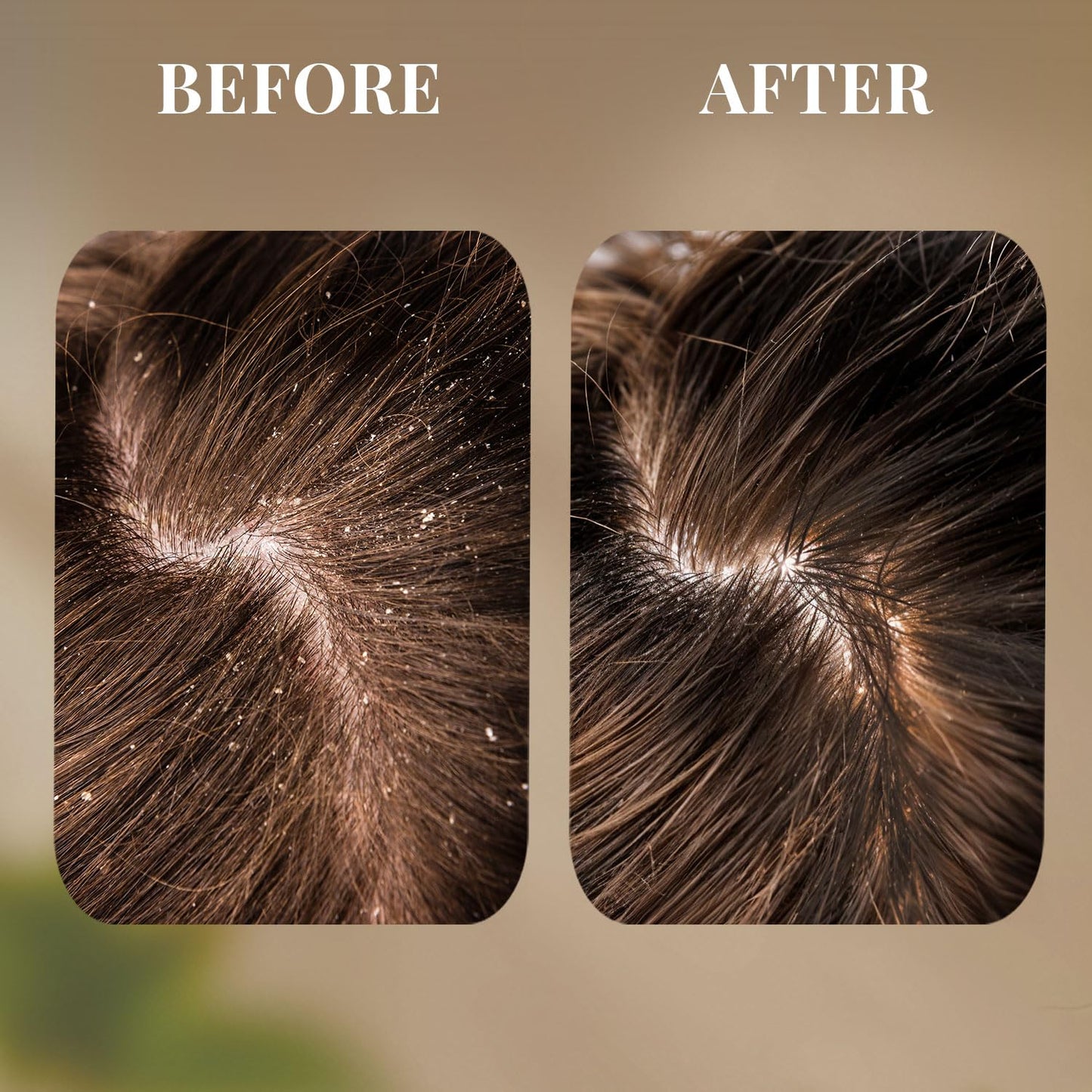 Just Herbs Ayurvedic Anti-Dandruff Shampoo, 200 ml