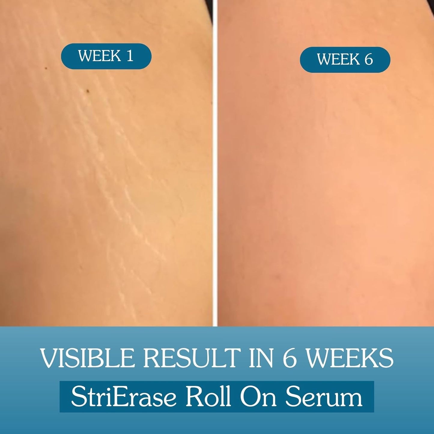 Bake StriErase Stretch Marks Removal Roll On Serum, 50 ml