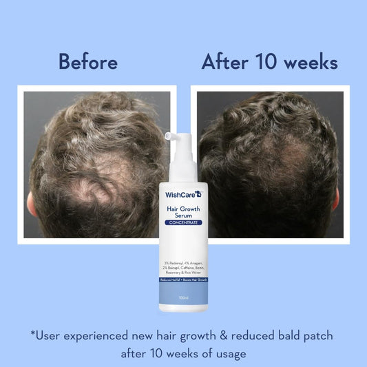 WishCare Hair Growth Serum Concentrate - 3% Redensyl, 4% Anagain, 2% Baicapil, Caffeine, Biotin & Rice Water, 100 ml
