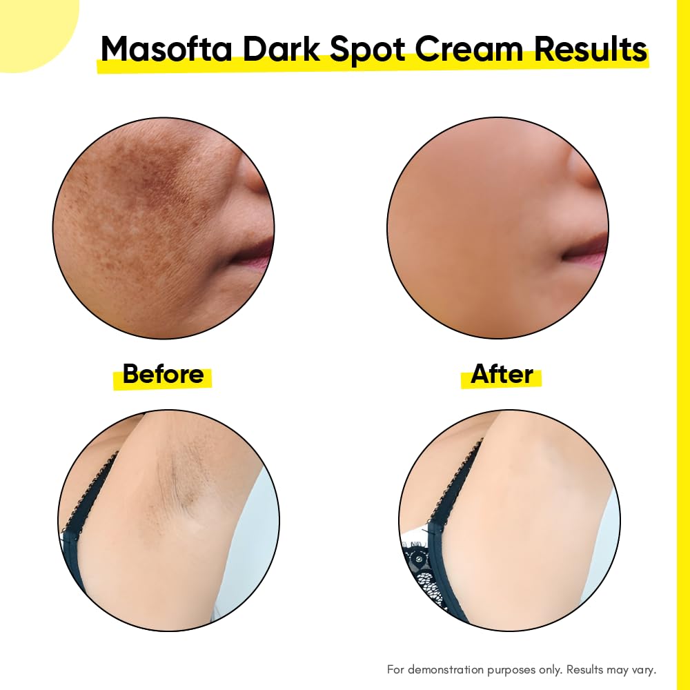 Masofta Dark Spot Reduction & Removal Cream for Melasma, Pigmentation, Acne Marks, 50 ml