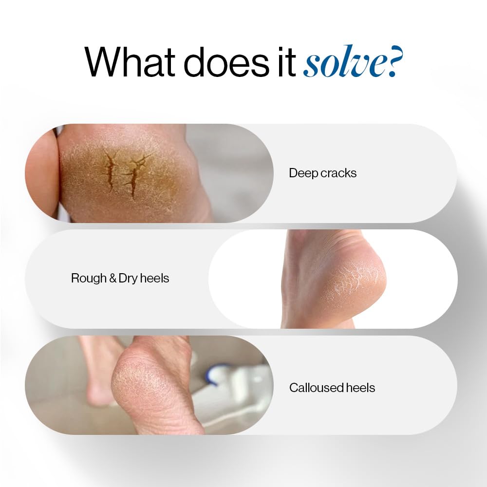 Be Bodywise 30% Urea Foot Cream Roll On, 50 ml