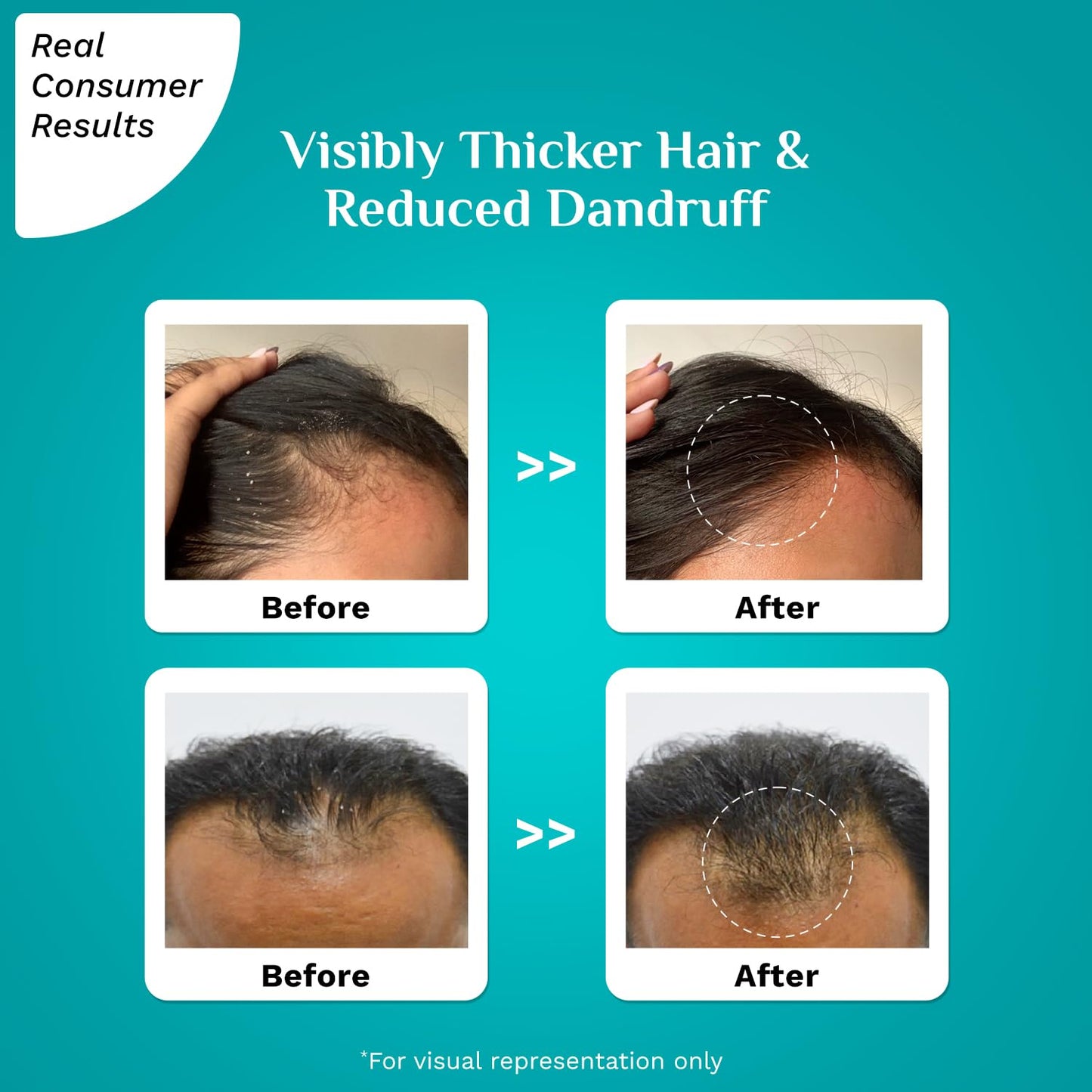 Pilgrim 3% Redensyl & 4% Anagain Advanced Hair Growth Serum, For Dandruff-Prone Scalp, 30 ml