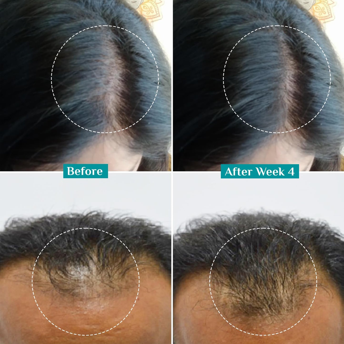 Pilgrim Redensyl 3% + Anagain 4% Advanced Hair Growth Serum with Korean Black Rice, 100 ml