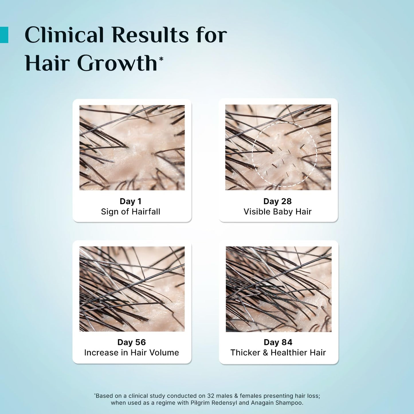 Pilgrim Redensyl 3% + Anagain 4% Advanced Hair Growth Serum with Korean Black Rice, 100 ml