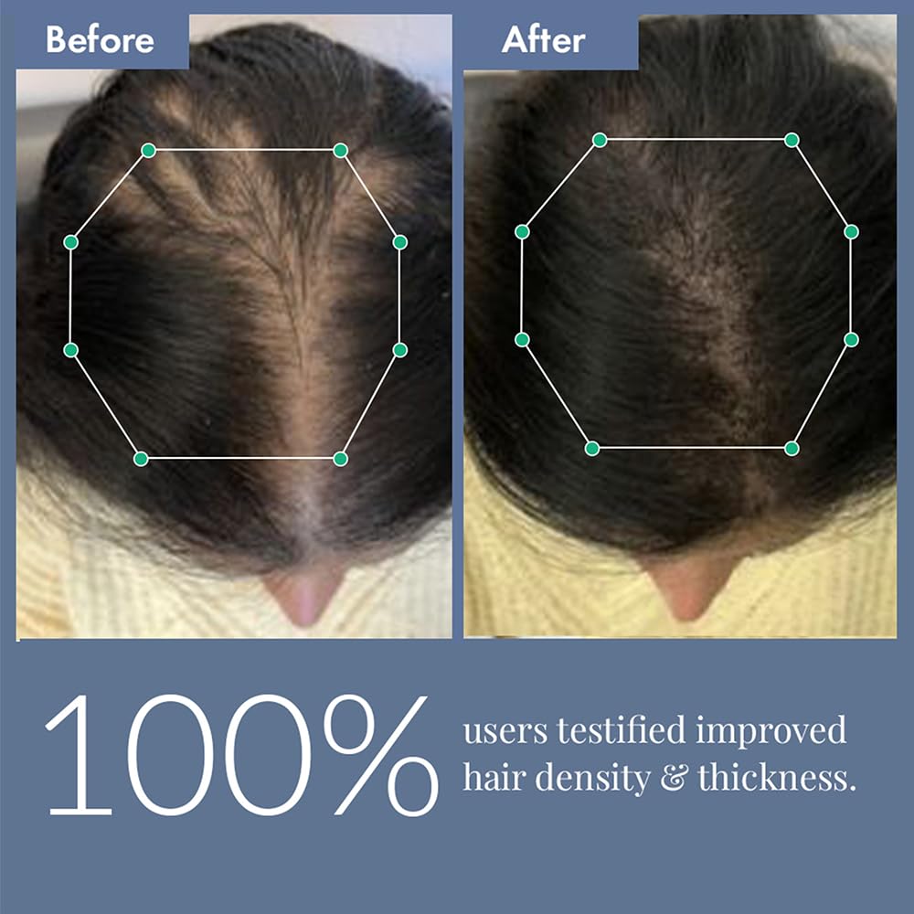 ThriveCo Hair Growth Serum 2.0 | Clinically Proven to Reduce Hair Fall & Boost Hair Growth | Powered by Redensyl, Procapil & Anagain | Backed by British Medical Research | Lightweight, Non-Sticky | For Men & Women – 30ml
