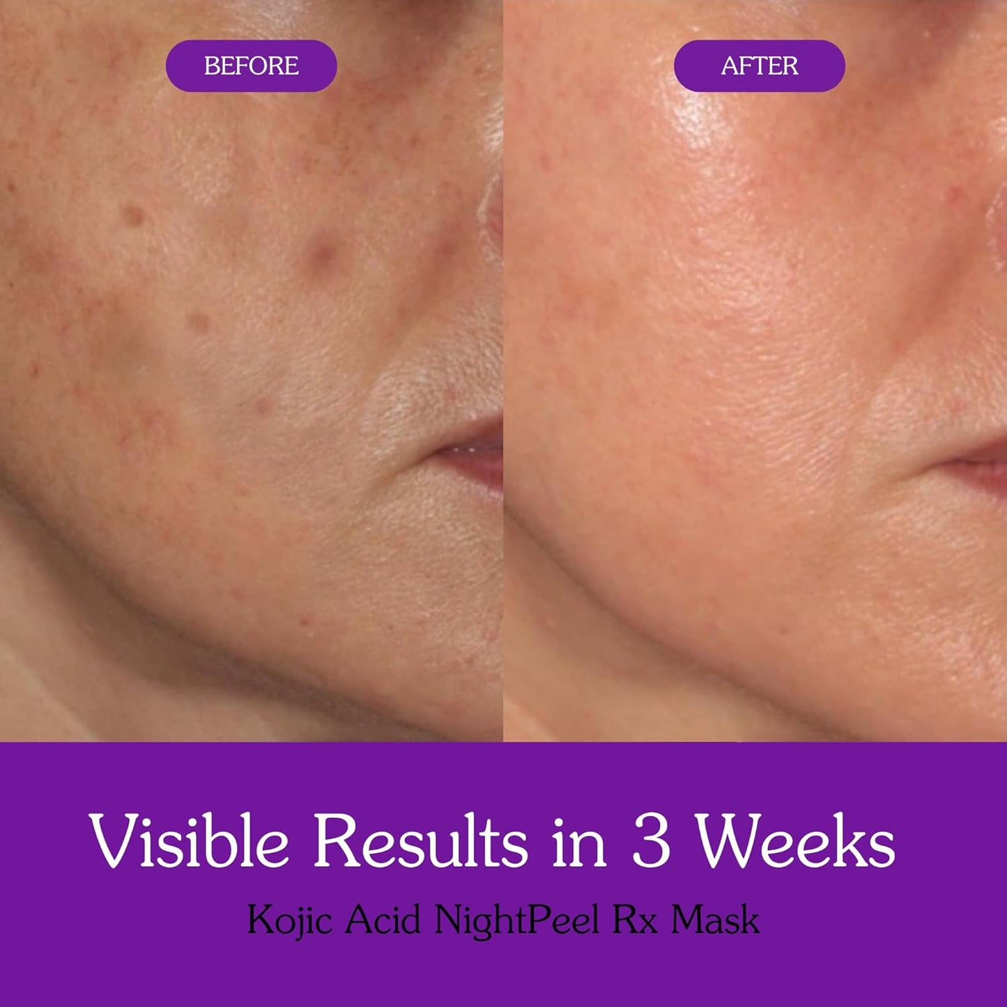 Bake 1% Kojic Acid Night Peel Off Mask with Niacinamide & Turmeric, 100 gm