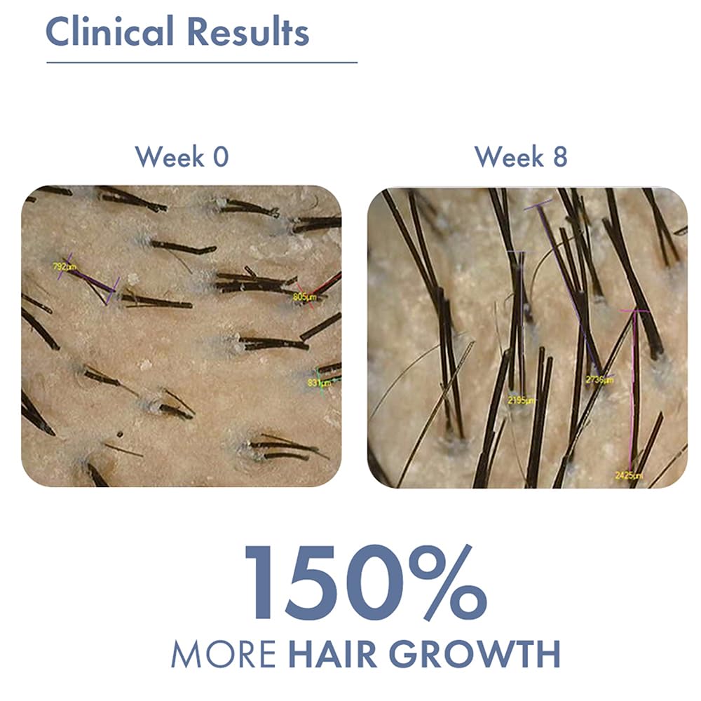 ThriveCo Hair Growth Serum 2.0 Roll On | Clinically Proven to Reduce Hair Fall & Boost Hair Growth | Powered by Redensyl, Procapil & Anagain | Backed by British Medical Research | Lightweight, Non-Sticky | For Men & Women – 10ml